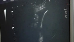 Почти 10 тыс. эндоваскулярных операций провели на Ставрополье по нацпроекту
